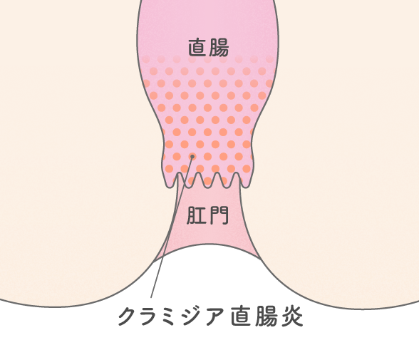 クラミジアの症状