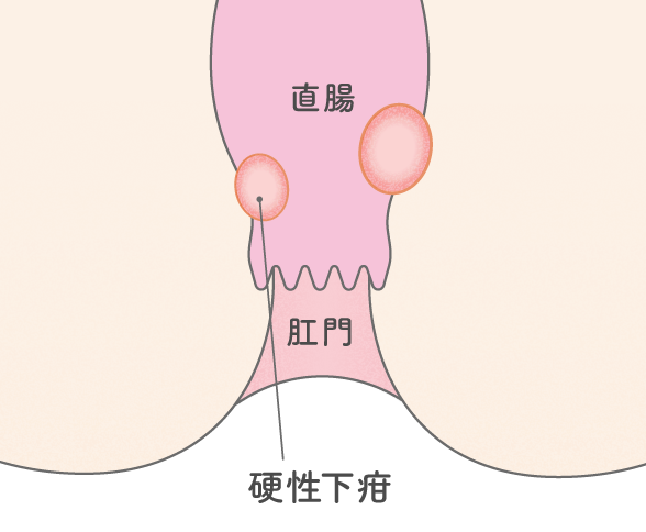 梅毒