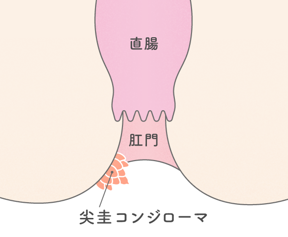 尖圭コンジローマ